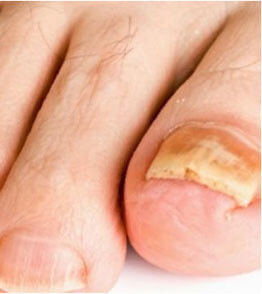 urgent-fungus-destroyer toe
