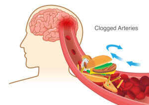 block red blood cell cause clogged in artery before into brain.