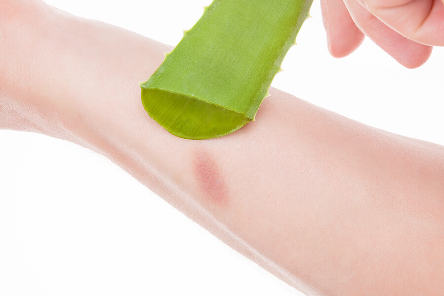 How to Naturally Treat a Burn at Home