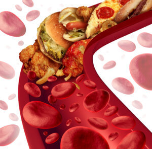 Cholesterol Blocked Artery