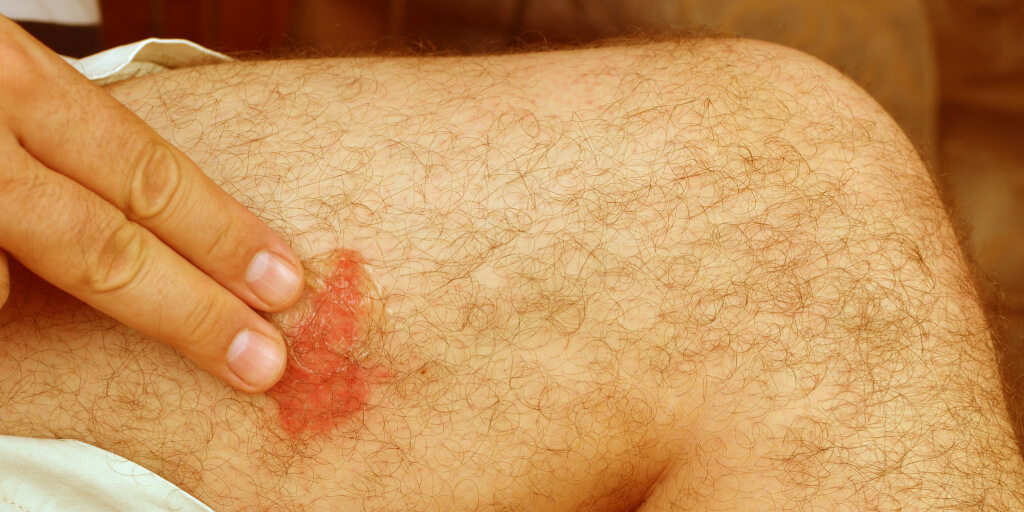 Natural Bee Sting Remedies for Quick Relief_Get Worse